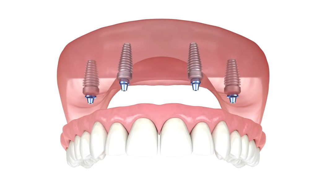 Implant Secured Dentures Video