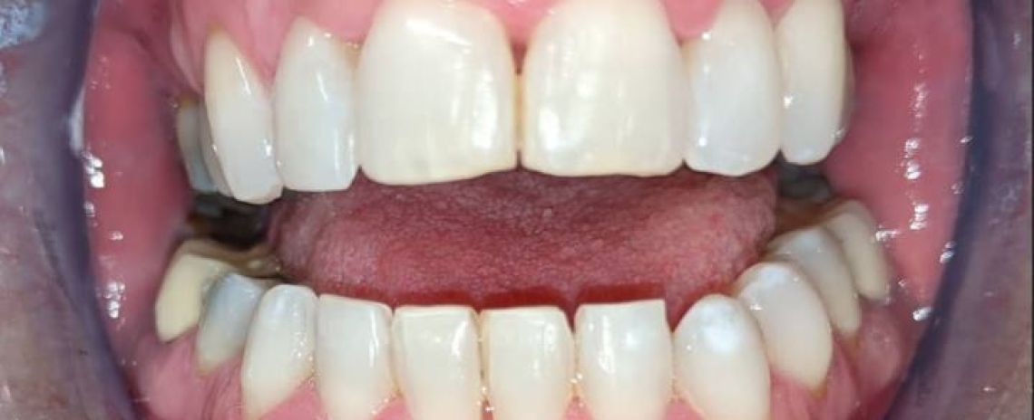 Kerry Invisalign and whitening After