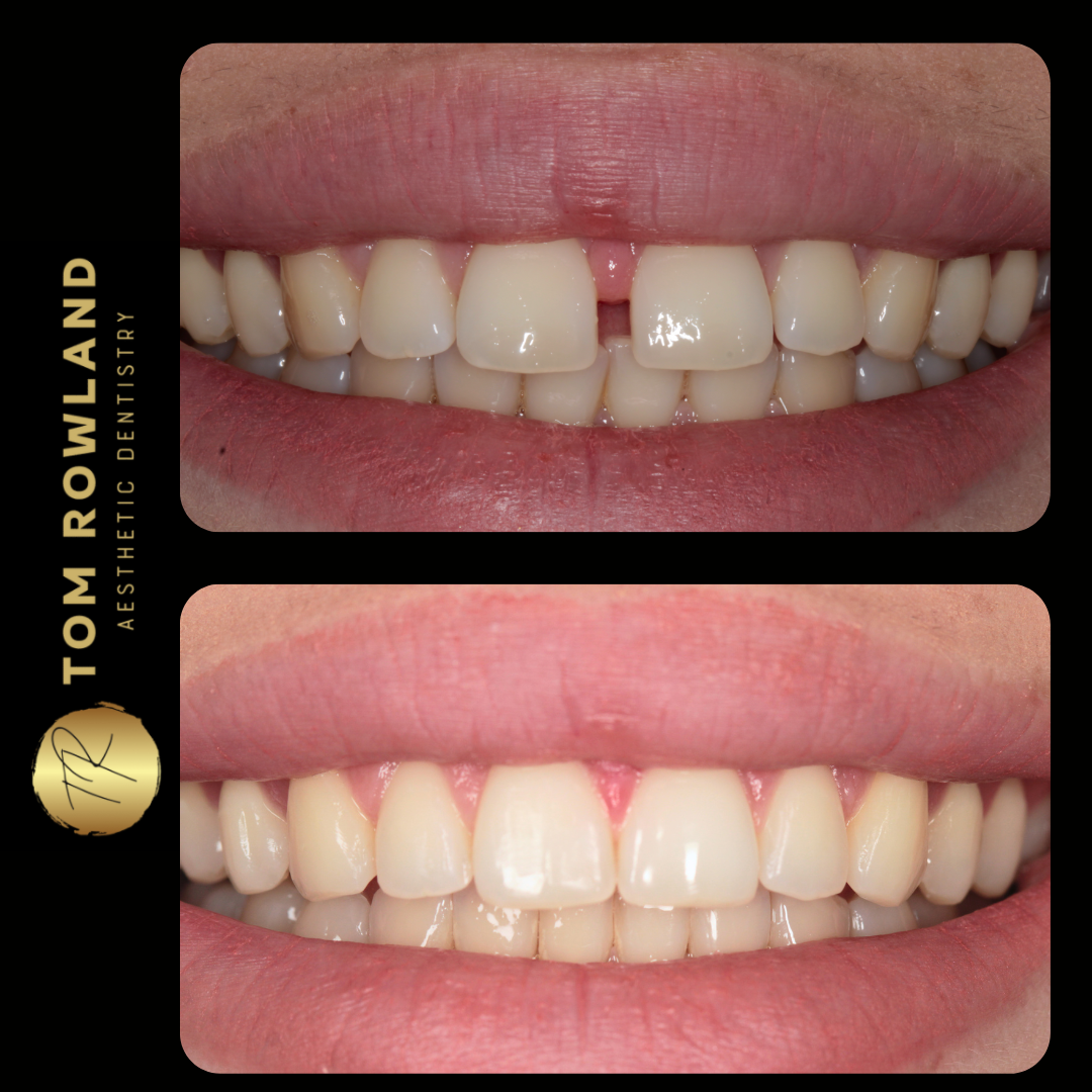 Invisalign Open Day – Monday 19th August