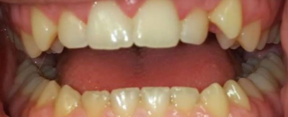 Leon Invisalign and whitening in 9 weeks Before