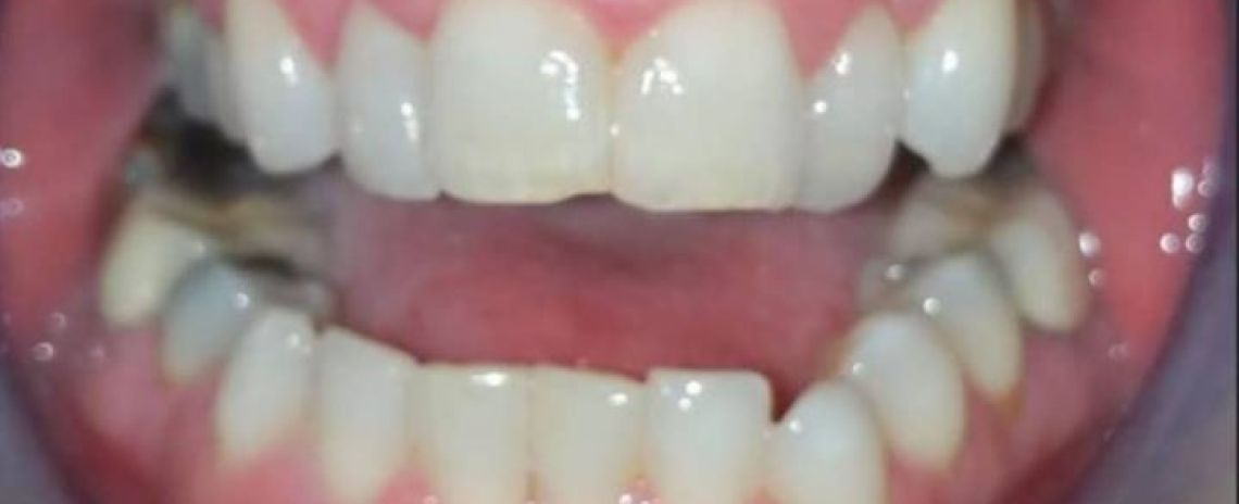Kerry Invisalign and whitening Before