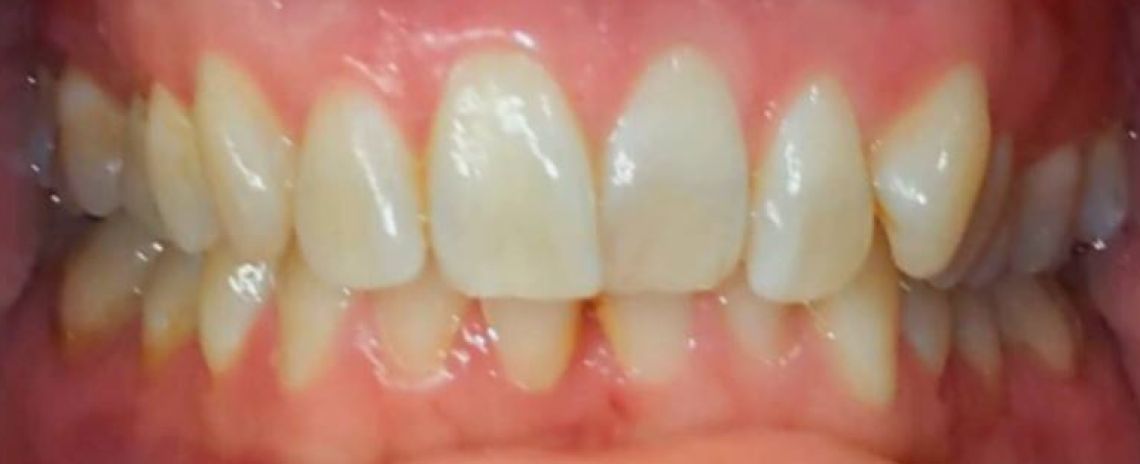 Keera Invisalign and whitening Before