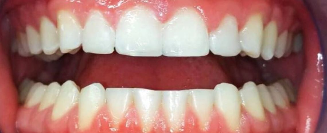   Align (3 months of Invisalign), Brighten (Philips Zoom Whitening), Contour(Composite bonding) After
