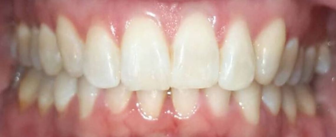 Keera Invisalign and whitening After