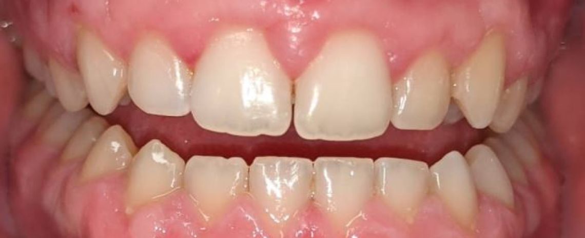 Leon Invisalign and whitening in 9 weeks After