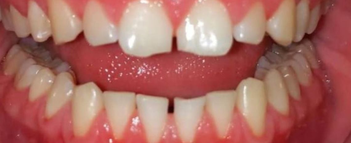   Align (3 months of Invisalign), Brighten (Philips Zoom Whitening), Contour(Composite bonding) Before