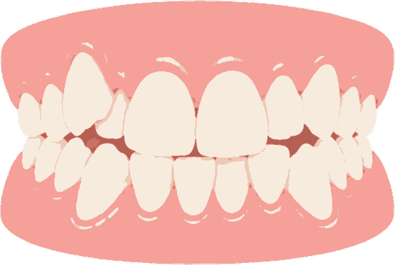 Illustration of crowded, overlapping teeth